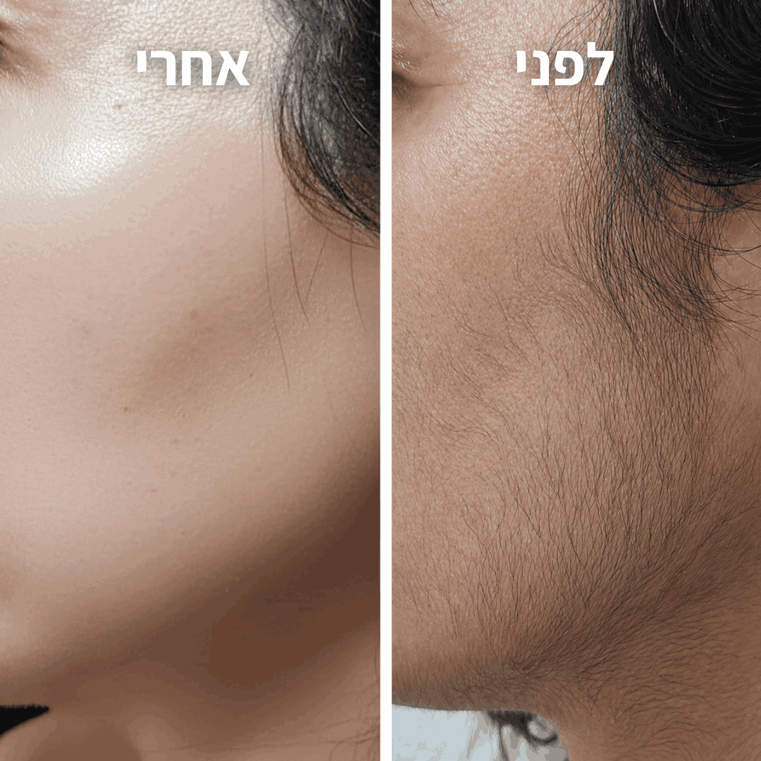 מסיר השיער של menela